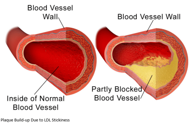 Blocked Blood Vessels