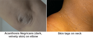 Insulin Resistance Skin Tags Acanthosis Negricans